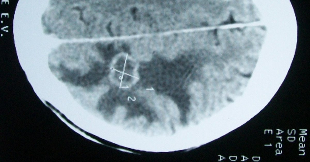 Edema cerebral tipos síntomas causas y tratamiento