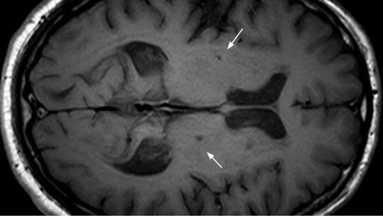 Escaneo cerebral que muestra rastros de un infarto cerebral.
