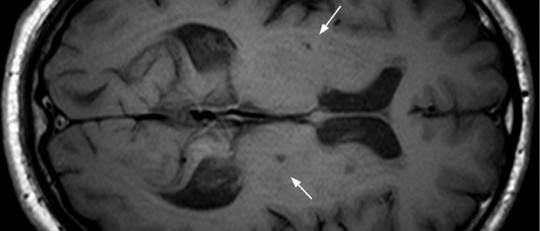 Escaneo cerebral que muestra rastros de un infarto cerebral.