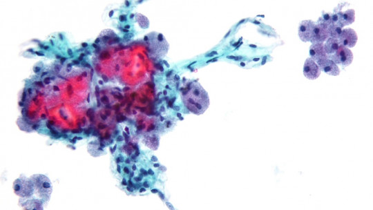 Imagen microscópica de una neoplasia.