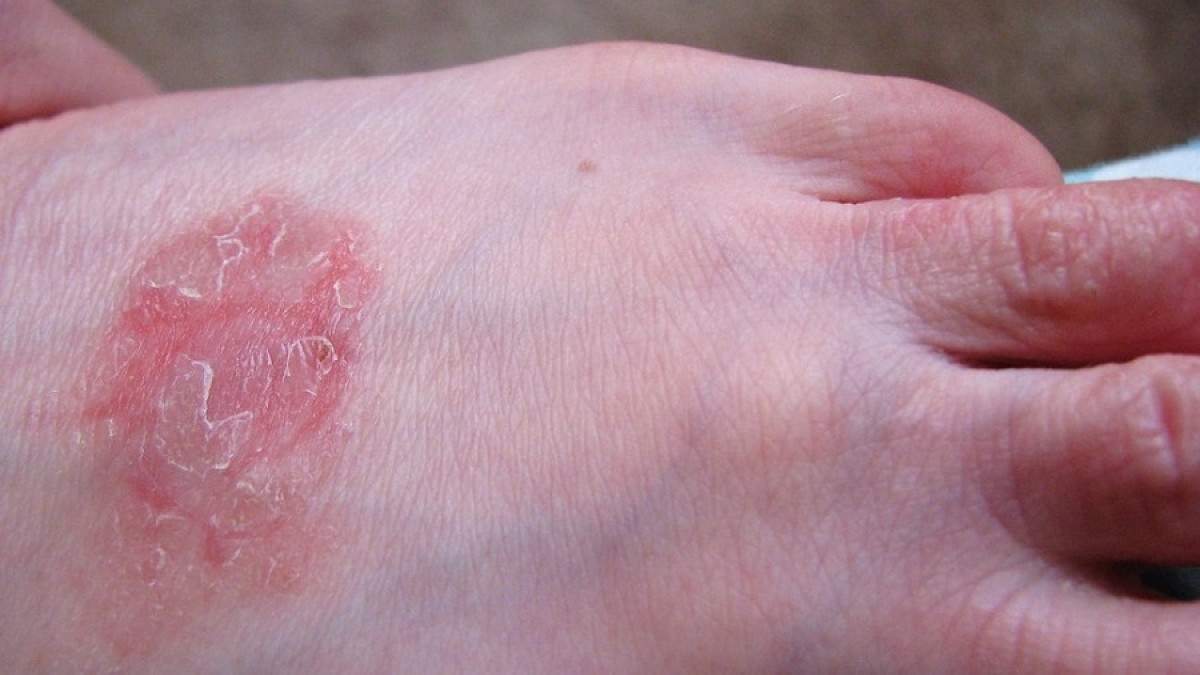 Abiertamente imagen muñeca Manchas rojas en la piel: 25 posibles enfermedades causantes, y síntomas