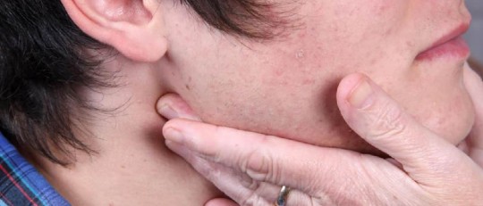 Ganglios inflamados.