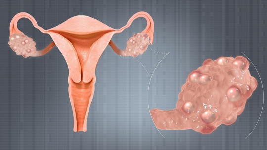 Síndrome de ovario poliquístico