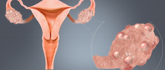 Síndrome de ovario poliquístico