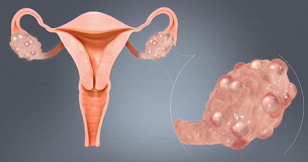 Síndrome De Ovario Poliquístico Síntomas Causas Y Efectos En El Cuerpo 6270