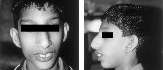 Niño con síndrome de Seckel.