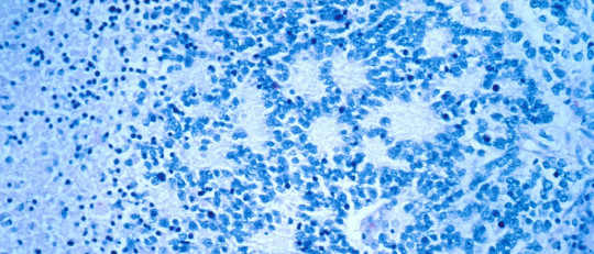 Neuroblastoma.