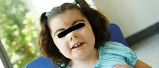 Niña con síndrome de Cornelia de Lange