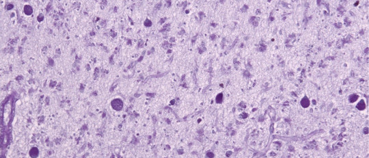 Enfermedad de Batten.