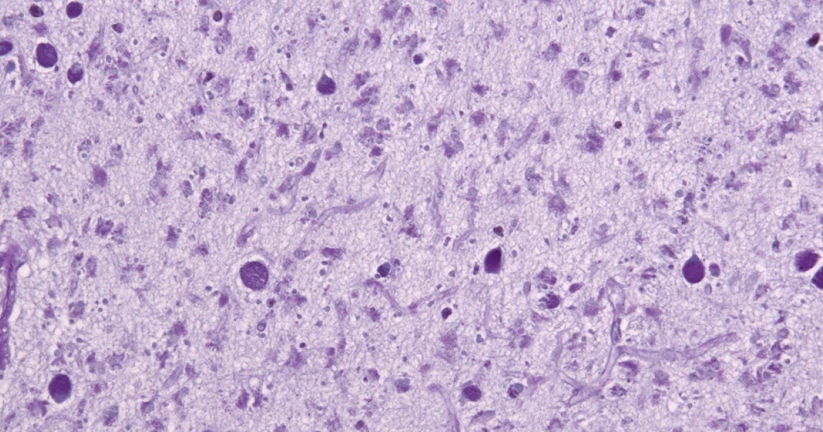 Enfermedad de Batten síntomas, causas y tratamiento Enfermedad de Batten síntomas, causas y tratamiento