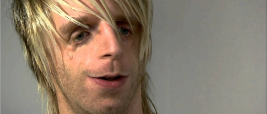 Sindrome de Treacher Collins.