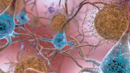 Descubren el origen del 30% de las placas amiloides del Alzheimer