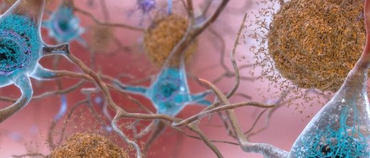 Descubren el origen del 30% de las placas amiloides del Alzheimer