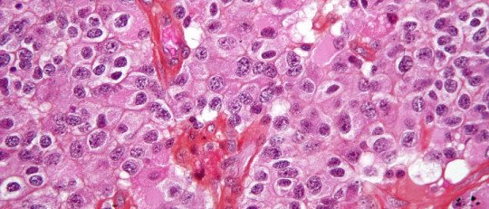 Así es como la IA está revolucionando la detección de Tumores Cerebrales