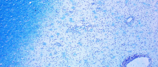 Tipos de enfermedad autoinmune