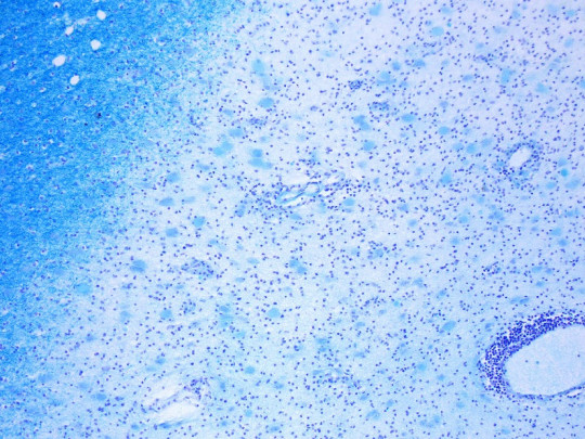 Tipos de enfermedad autoinmune