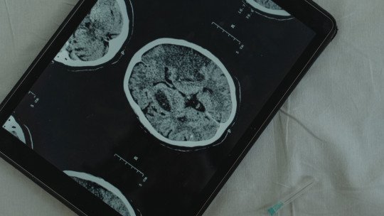 Por qué la diabetes tipo 2 cambia el cerebro de un modo similar al Alzheimer