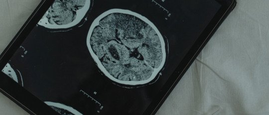 Por qué la diabetes tipo 2 cambia el cerebro de un modo similar al Alzheimer