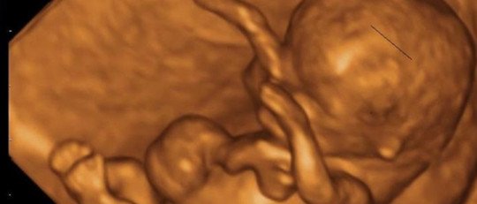 El consumo de cannabis durante el embarazo aumenta el riesgo de psicosis en el bebé