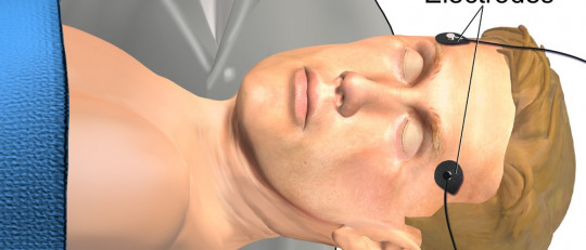 Terapia electroconvulsiva