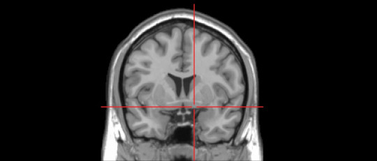 Núcleo basal de Meynert