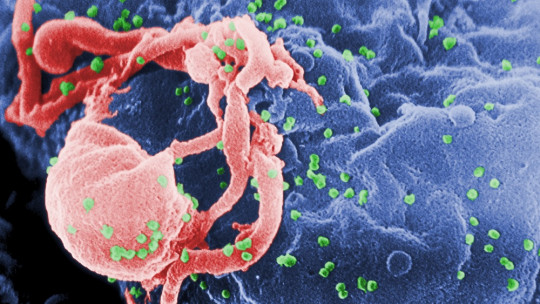 Demencia asociada a VIH
