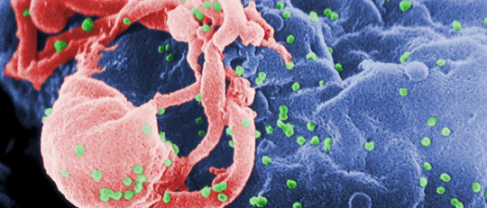 Demencia asociada a VIH