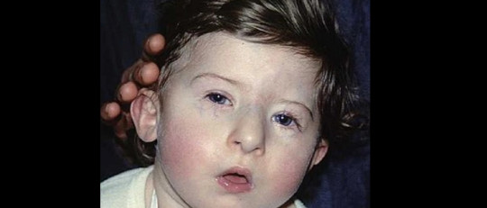 Síndrome de DiGeorge