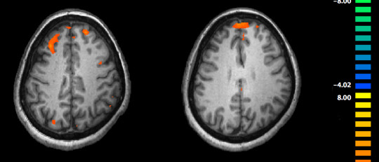 Una investigación descubre que la esquizofrenia es la manifestación de ocho mutaciones genéticas