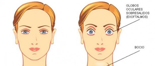 Enfermedad de Graves-Basedow