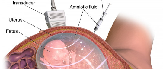 Amniocentesis