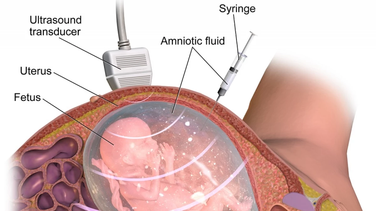 líquido amniótico riesgos de prueba de adn en el embarazo