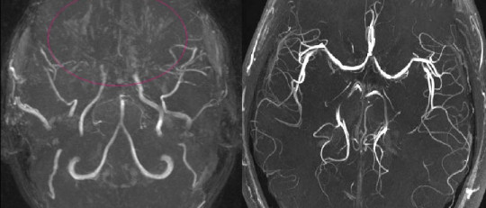 Enfermedad de Moyamoya