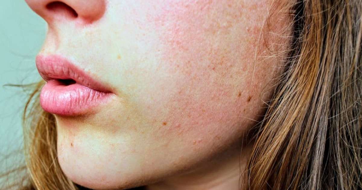 Carretilla estético artículo Cómo quitar las cicatrices del acné: 8 consejos