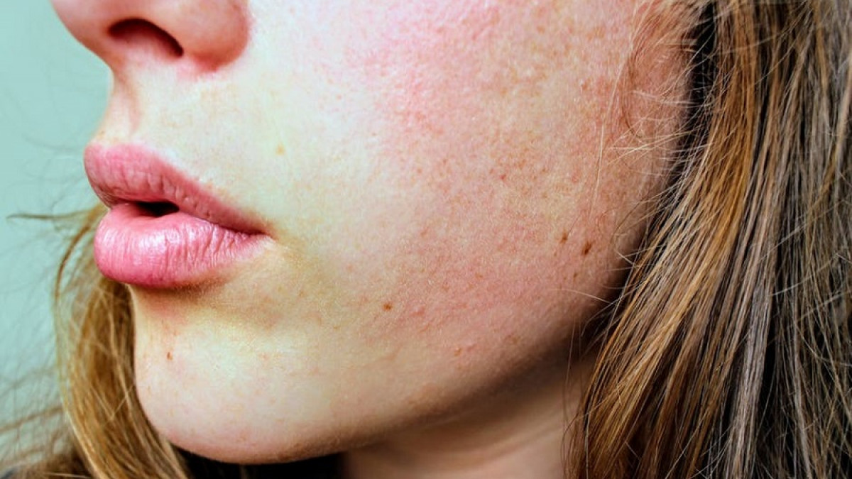 Cómo las cicatrices del acné: 8
