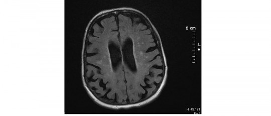 Enfermedad de Binswanger