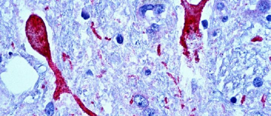 Encefalopatía TDP-43