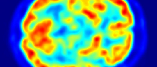 Hipersexualidad: ¿qué ocurre en el cerebro de un adicto al sexo?