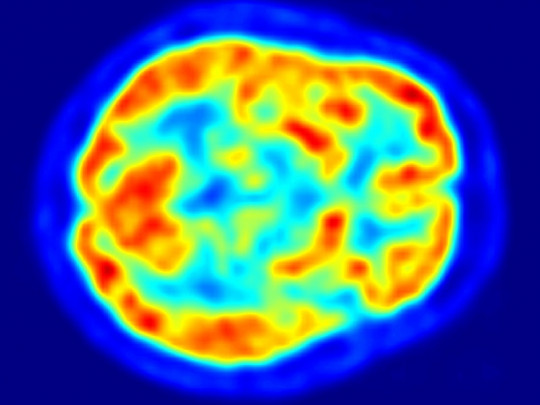 Hipersexualidad: ¿qué ocurre en el cerebro de un adicto al sexo?