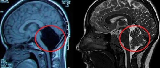 El insólito caso de una mujer sin cerebelo que ha sorprendido a la comunidad científica