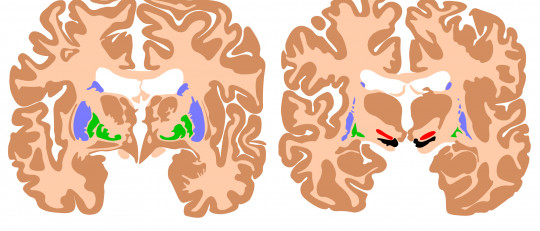 15 alimentos que dañan la salud de nuestro cerebro