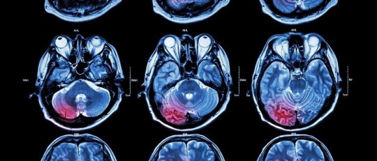 Diferencias entre la neuropsicología y la neurología