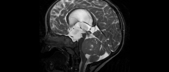 Meduloblastoma