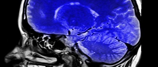 El sedentarismo provoca cambios en el cerebro