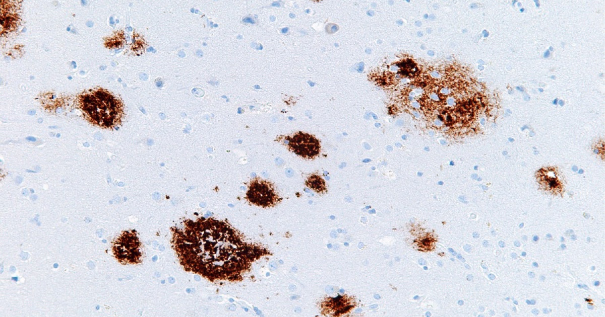 Día De La Conciencia De Alzheimer Diagnóstico De Demencia Enfermedad De