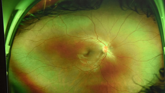 Partes de la retina