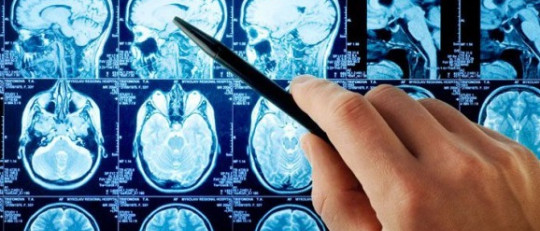 Aneurisma cerebral: causas, síntomas y pronóstico