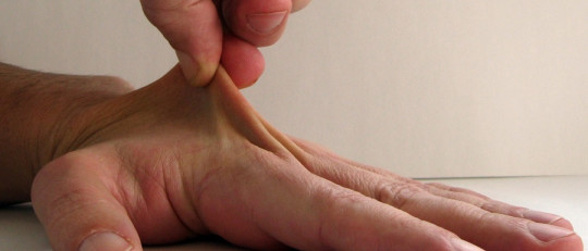 Síndrome de Ehlers-Danlos