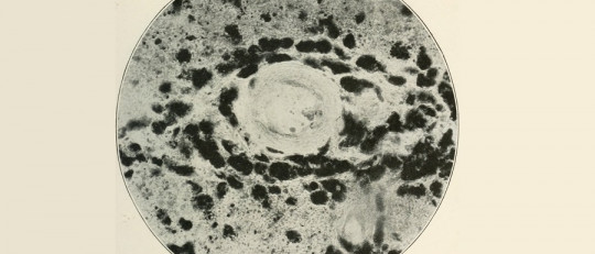 Polineuropatías desmielinizantes