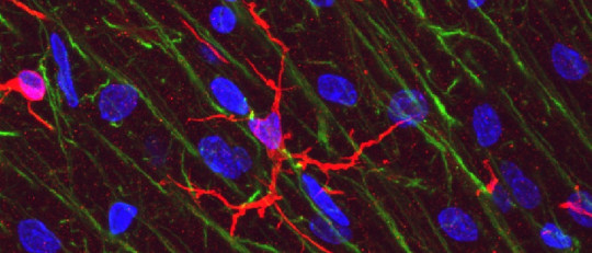 Síndrome de Guillain-Barré